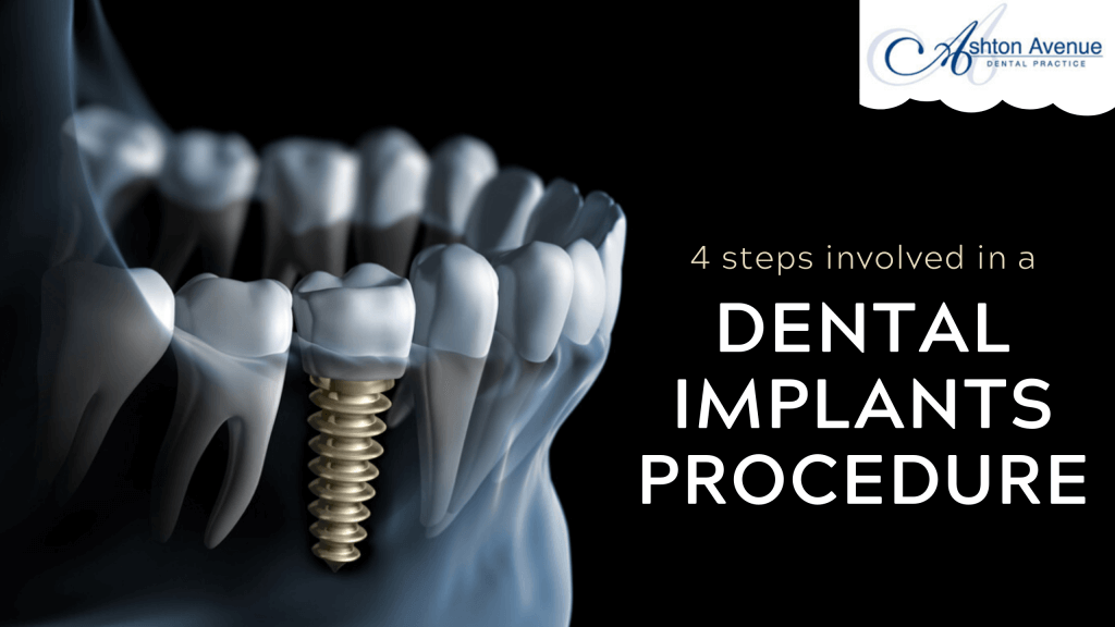 Dental Implant Procedure Step By Step Missing Teeth Replacement Claremont Dental Blog 